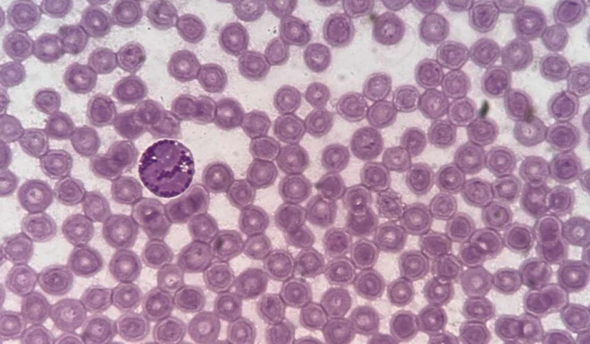 Anaplasmosis: What Is, Causes, Symptoms, Diagnosis and Complications