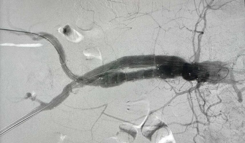 Aneurysm: What Is, Causes, Types, Symptoms, and Treatment