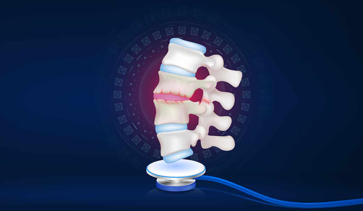 Ankylosing Spondylitis: What Is, Causes, Symptoms, and Diagnosis