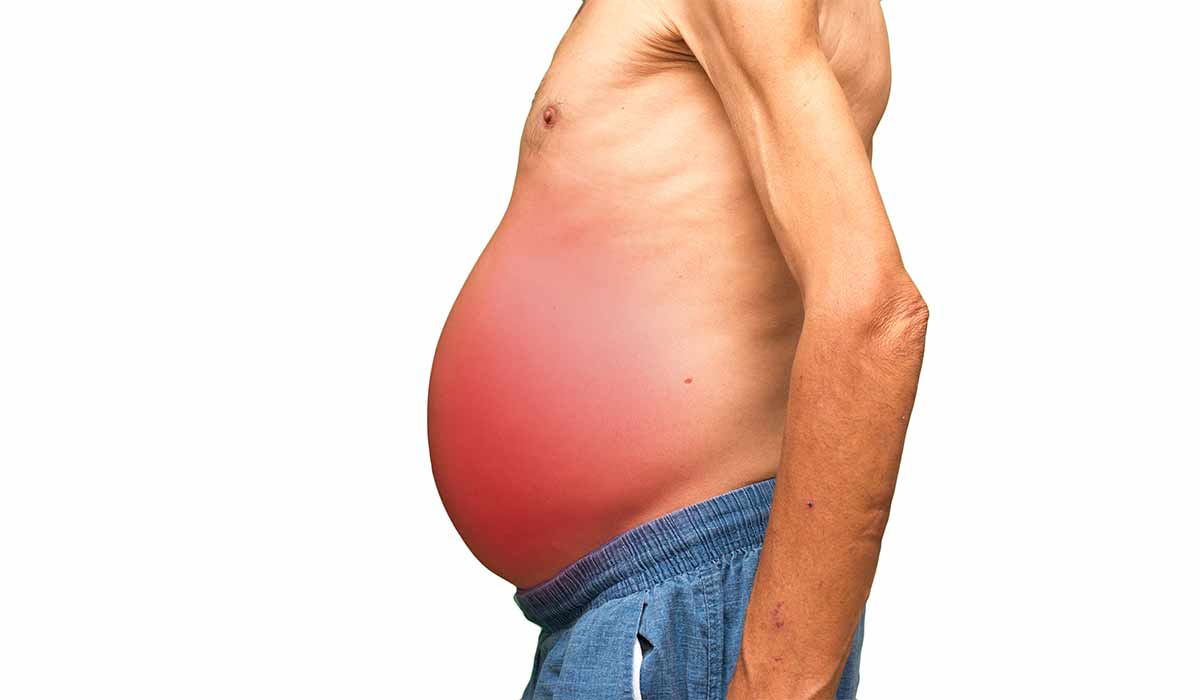 Ascites: What Is, Causes, Risk Factors, Treatment, and Prevention