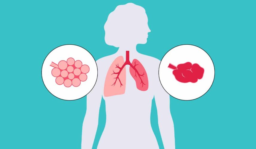 Atelectasis: What Is, Causes, Symptoms, Treatment, and Prevention