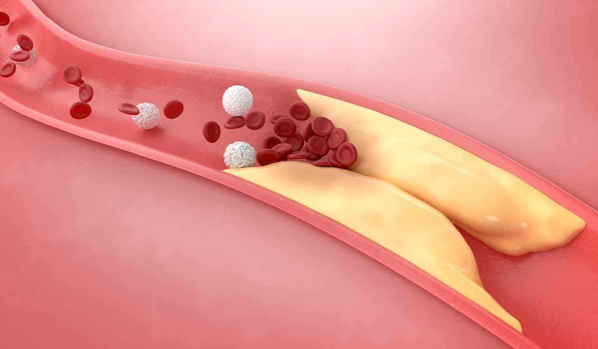 Atherosclerosis: What Is, Symptoms, Causes, and Complications