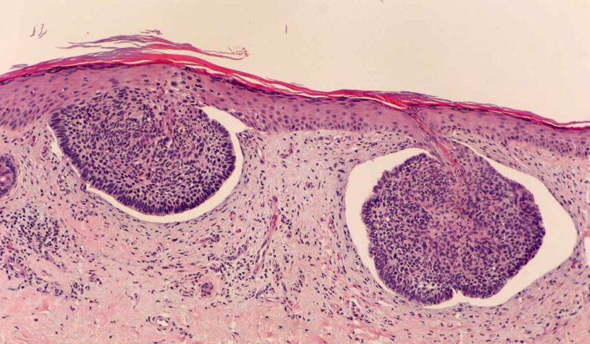 Basal Cell Carcinoma: What Is, Types, Causes, Symptoms, and Treatment