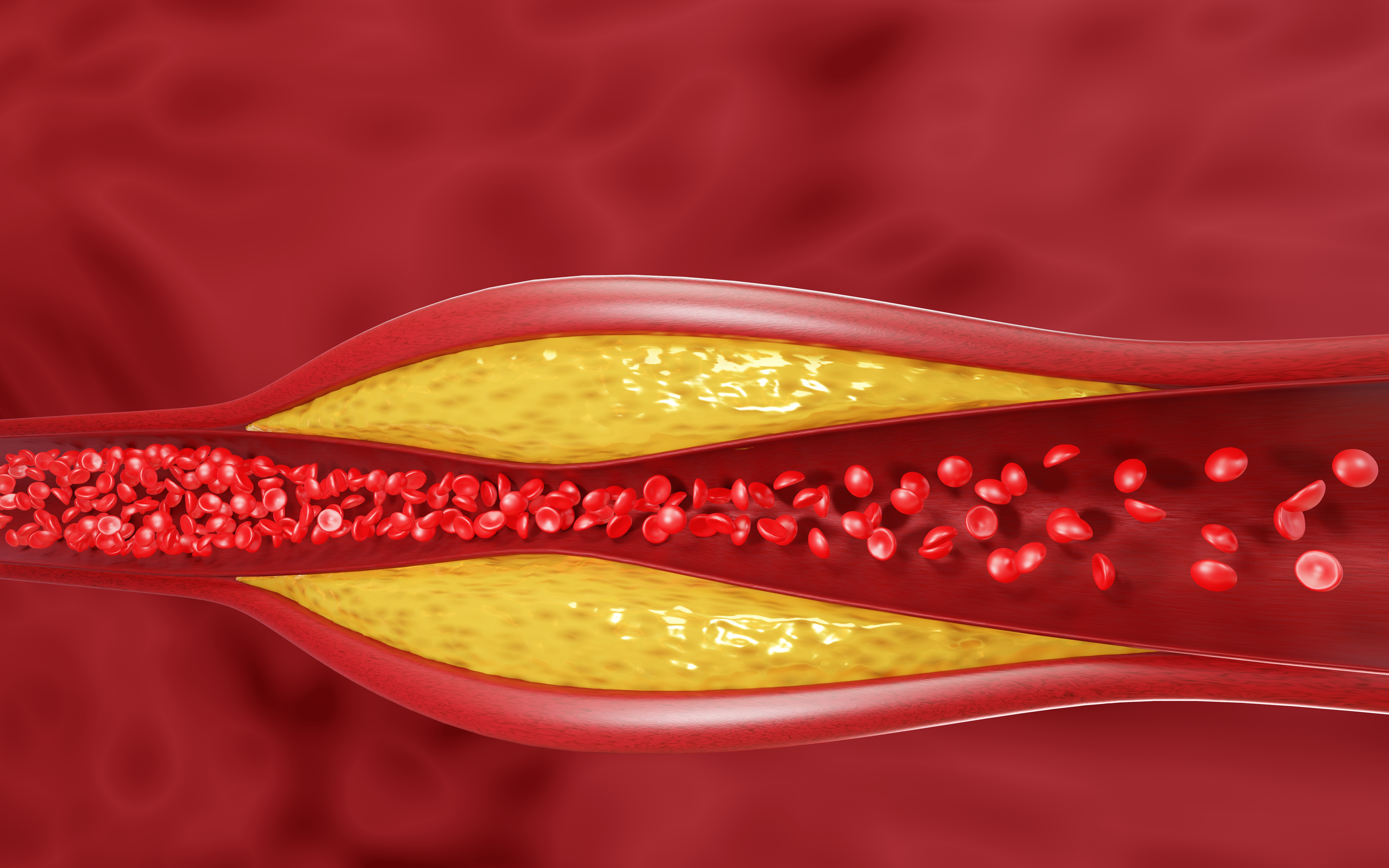 Hyperlipidemia: What Is, Causes, Treatment, and More