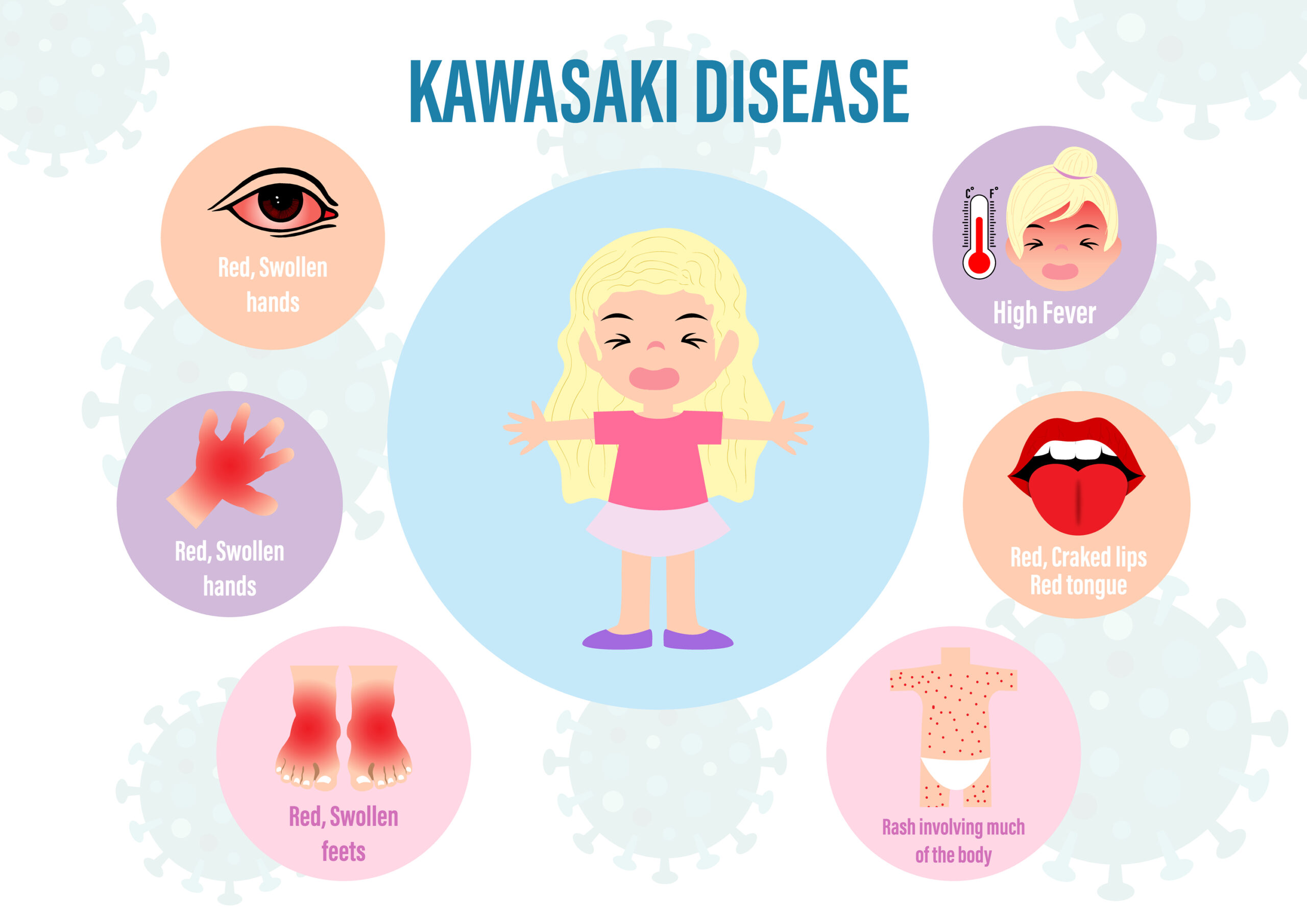 Kawasaki Disease What Is Symptoms Diagnosis And Treatment Kawasaki Disease What Is Symptoms Diagnosis And Treatment
