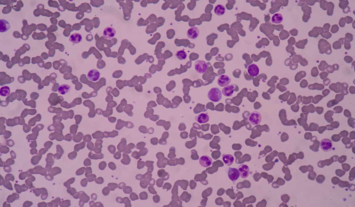 Leukocytosis: What Is, Types, Causes, Diagnosis, and Symptoms