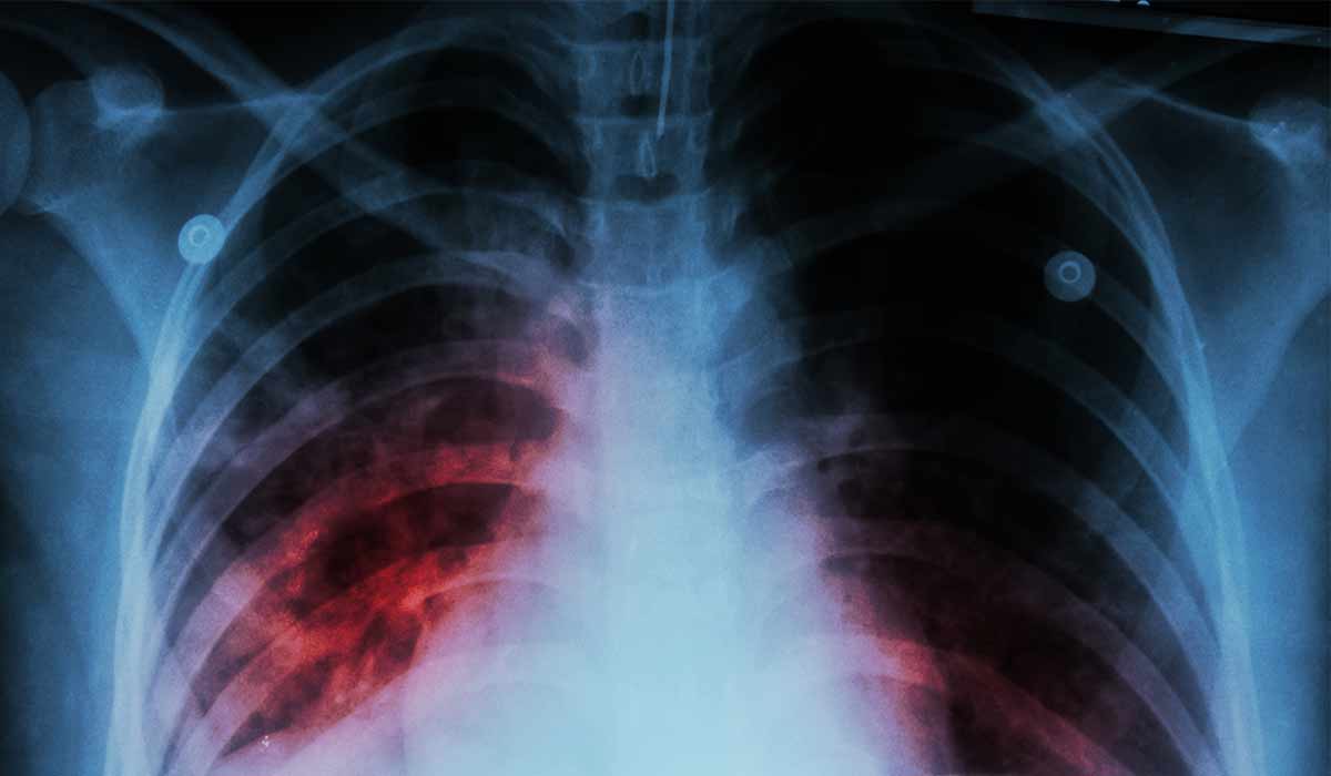 Tuberculosis: What Is, Diagnosis, Types, Risk Factor, and Prevention
