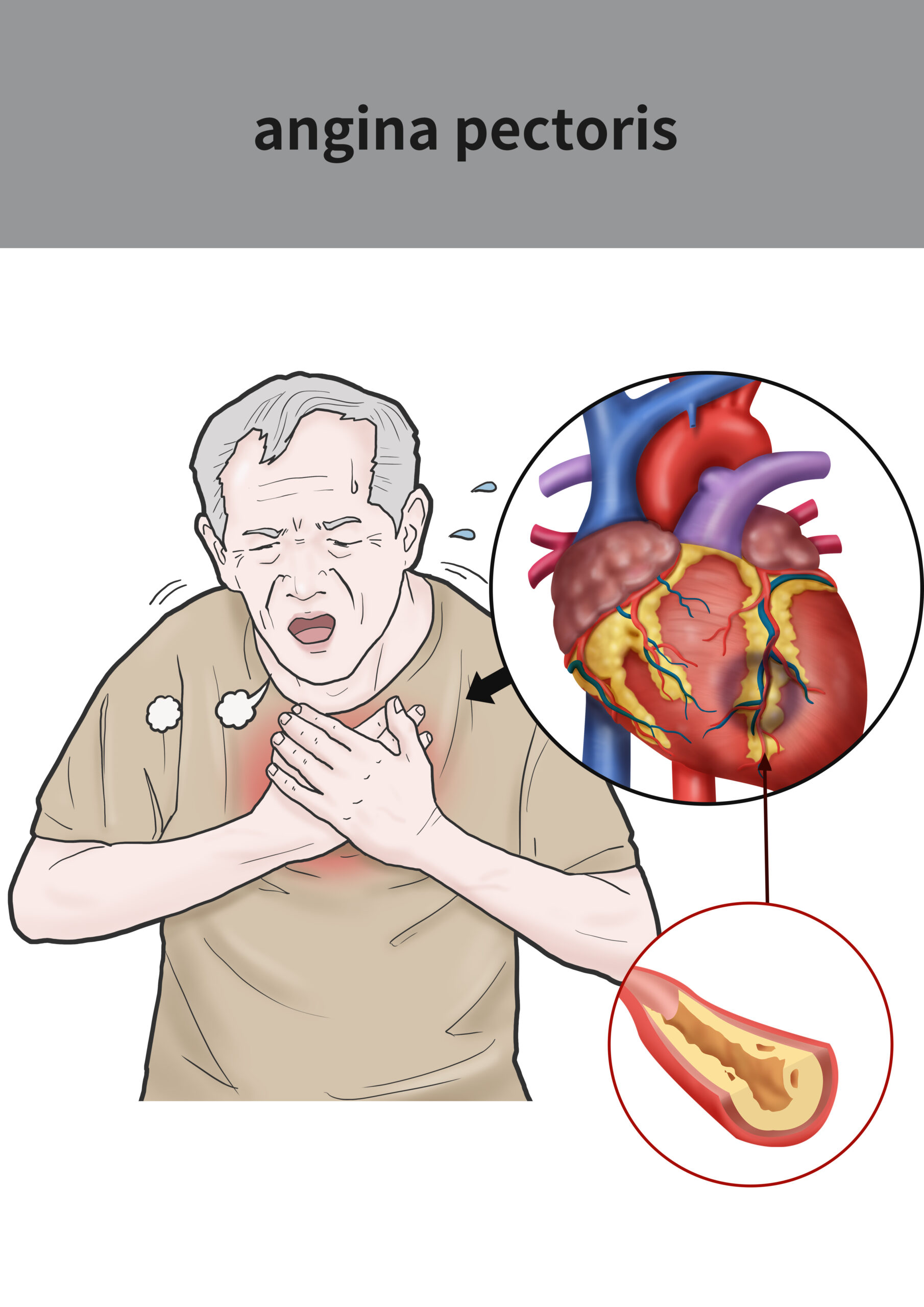 Angina Pectoris: What Is, Causes, Symptoms, Risk Factors, and Prevention