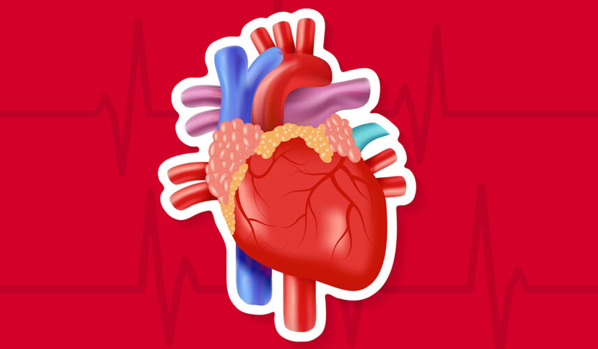 Atrial Fibrillation (AFib): What Is, Causes, Triggers, and Treatment