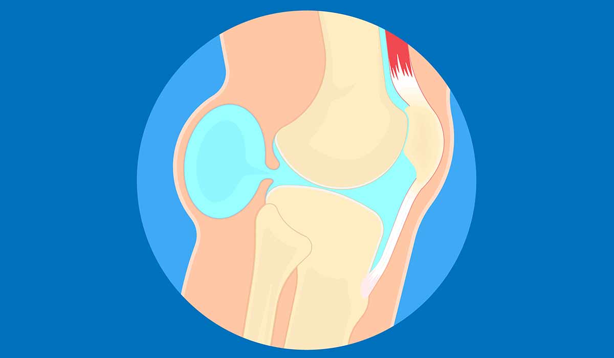 Baker's Cyst: What Is, Causes, Risk Factors, Treatment, and Prevention
