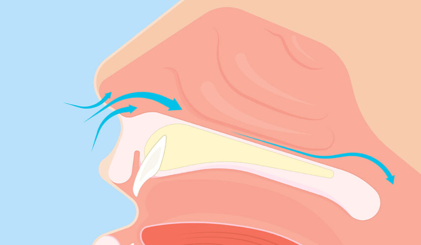 Deviated Septum: What Is, Causes, Symptoms, and Diagnosis