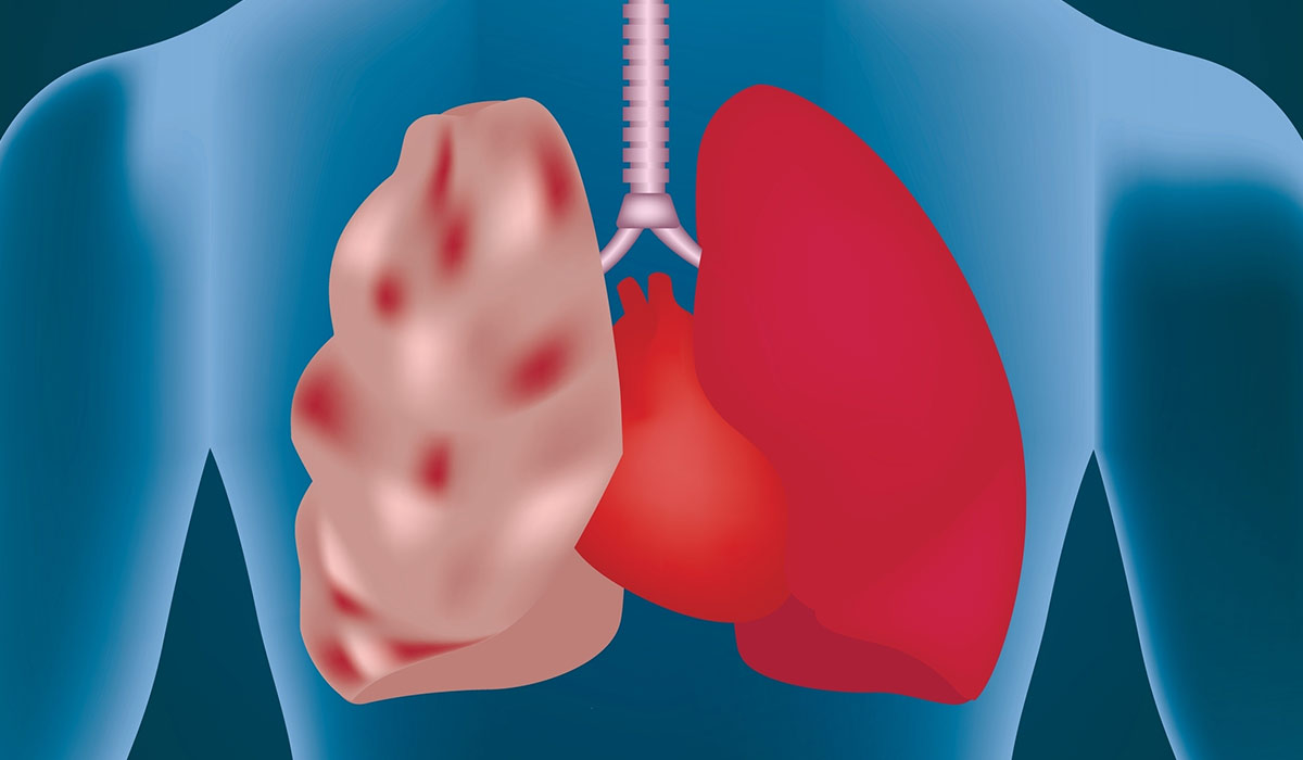 Emphysema: What Is, Causes, Diagnosis, and Symptoms