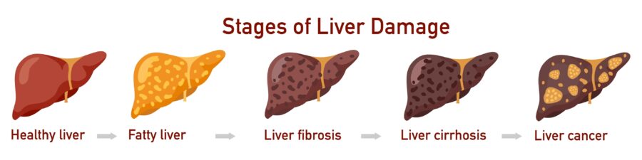 Fatty Liver: What Is, Causes, Diagnosis, and Treatment