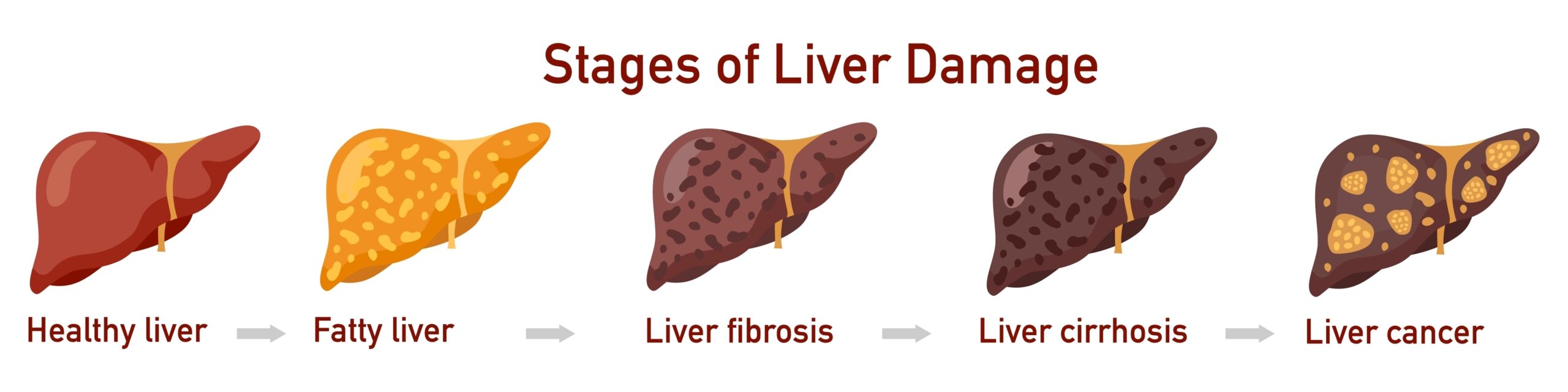 Fatty Liver: What Is, Causes, Diagnosis, and Treatment