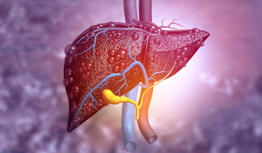 Fatty Liver: What Is, Causes, Diagnosis, and Treatment