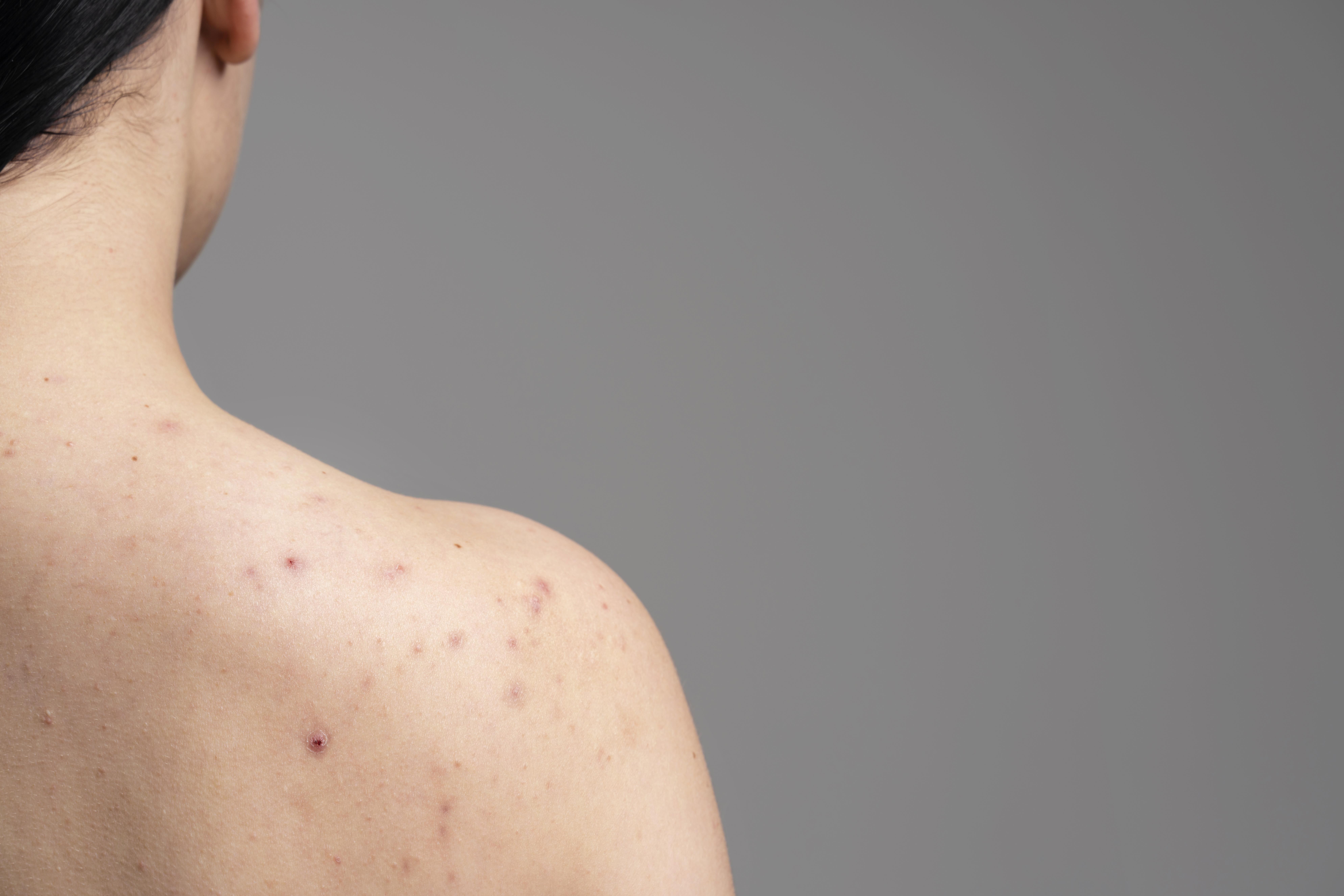 Folliculitis: What Is, Causes, Symptoms, Treatment, and Prevention