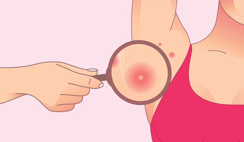 Folliculitis: What Is, Causes, Symptoms, Treatment, and Prevention
