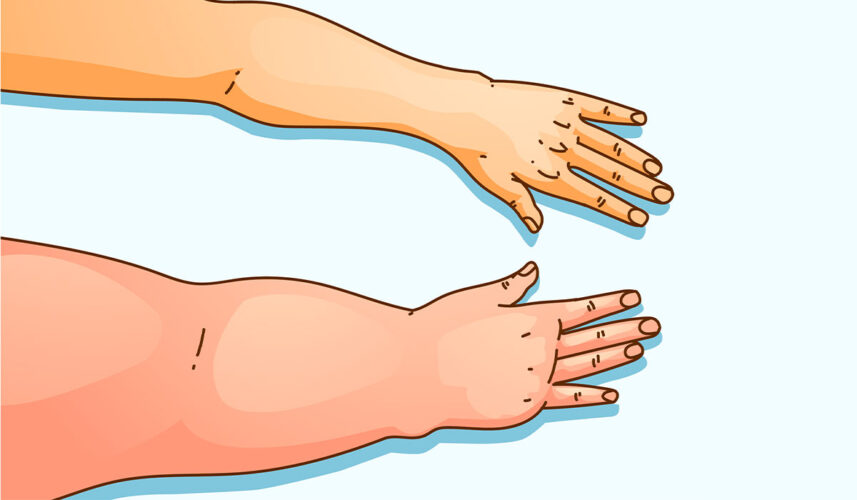 Lymphedema: What Is, Causes, Symptoms, Diagnosis, and Treatment