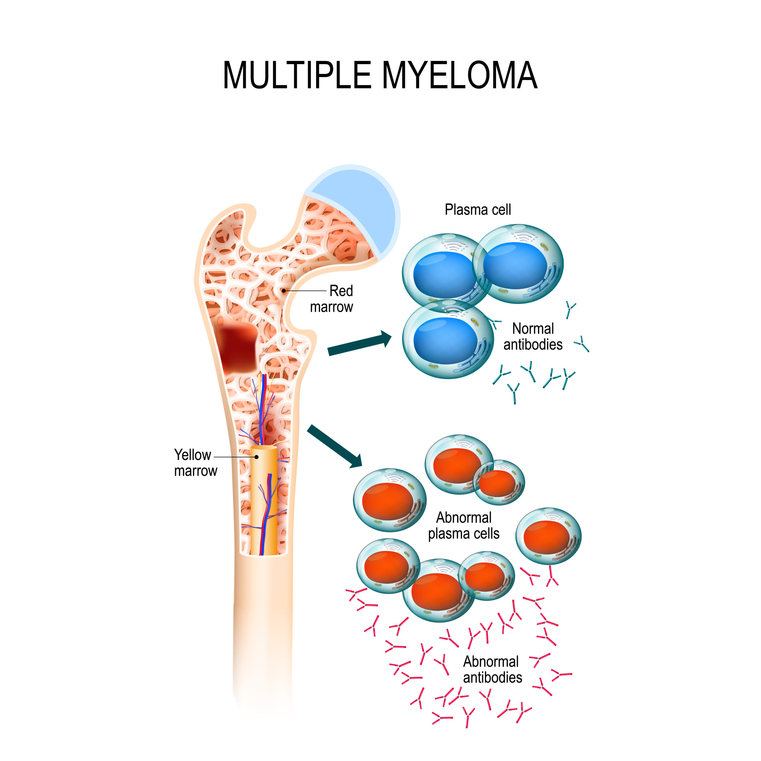 Multiple Myeloma: What Is, Symptoms, and Treatment