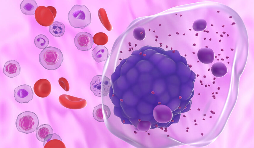 Multiple Myeloma: What Is, Symptoms, and Treatment