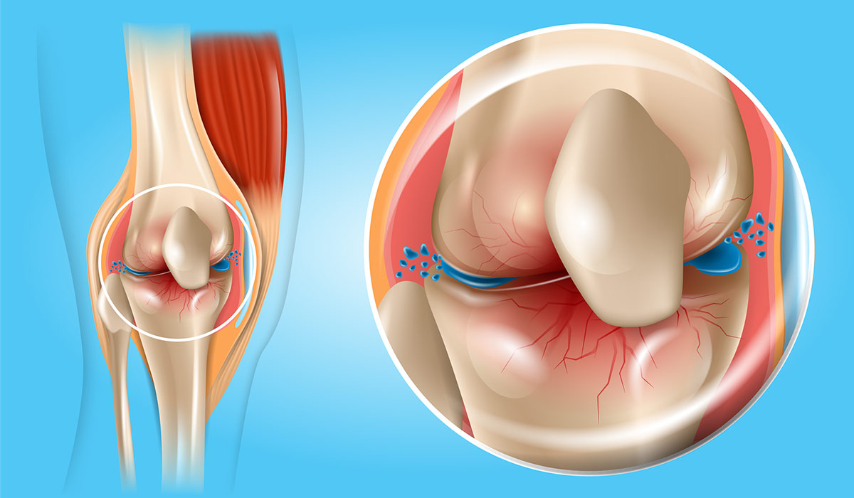 Osteoarthritis: What Is, Causes, Symptoms, Diagnosis, and Treatment
