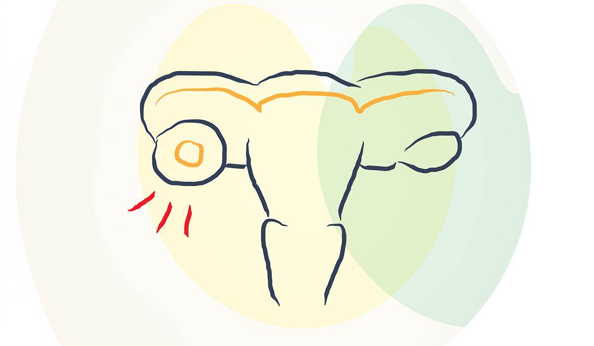 Ovarian Cyst: What Is, Types, Symptoms, Diagnosis, and Treatment