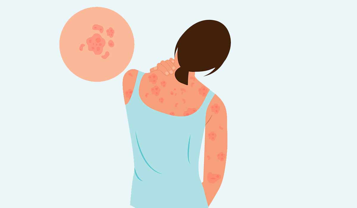 Psoriasis: What Is, Causes, Types, Diagnosis, and Symptoms