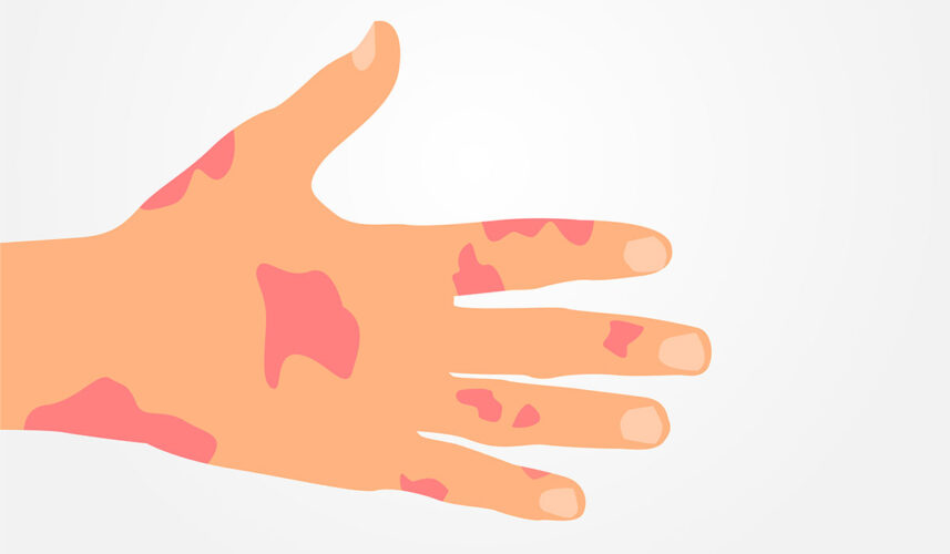 Psoriatic Arthritis: What Is, Symptoms, Diagnosis, and Treatment