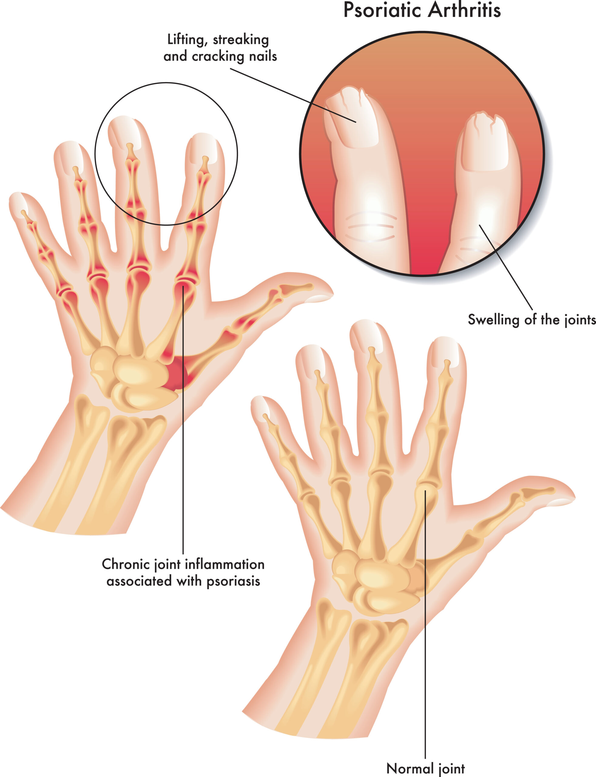 Psoriatic Arthritis: What Is, Symptoms, Diagnosis, and Treatment