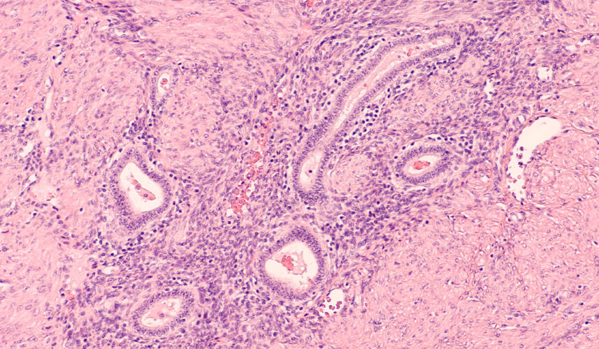 Adenomyosis: What Is, Causes, Symptoms, Diagnosis, and Risk Factors