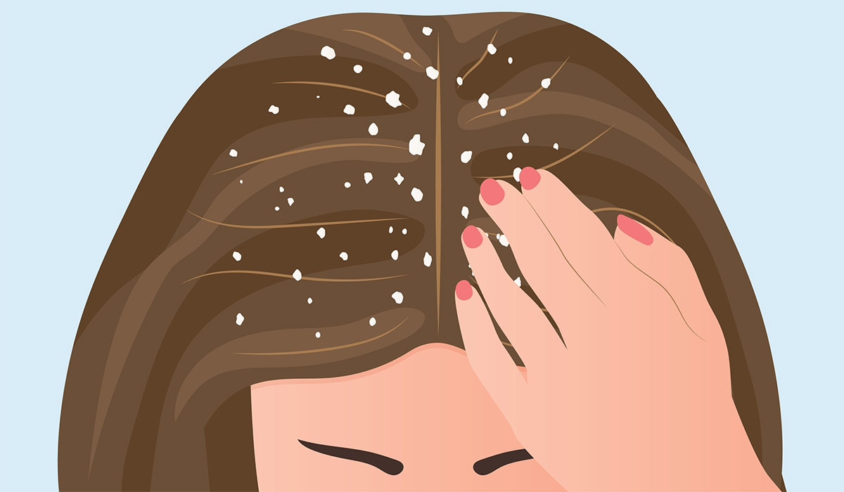 Dandruff: What Is, Symptoms, Causes, Types, and Diagnosis