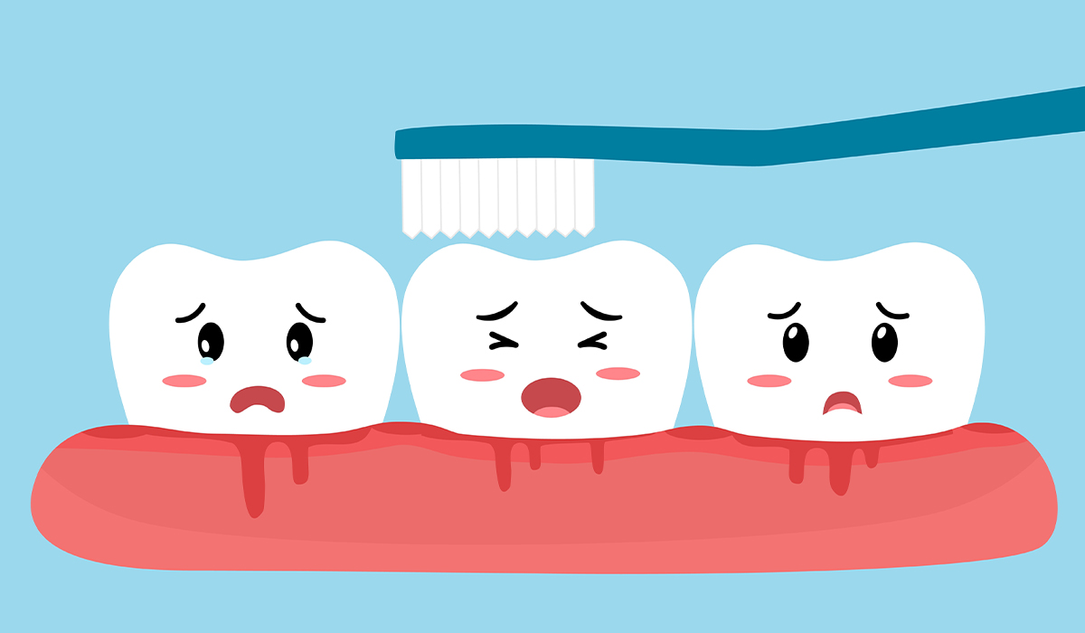 Gingivitis: What Is, Risk Factors, Symptoms, Treatment, and Prevention