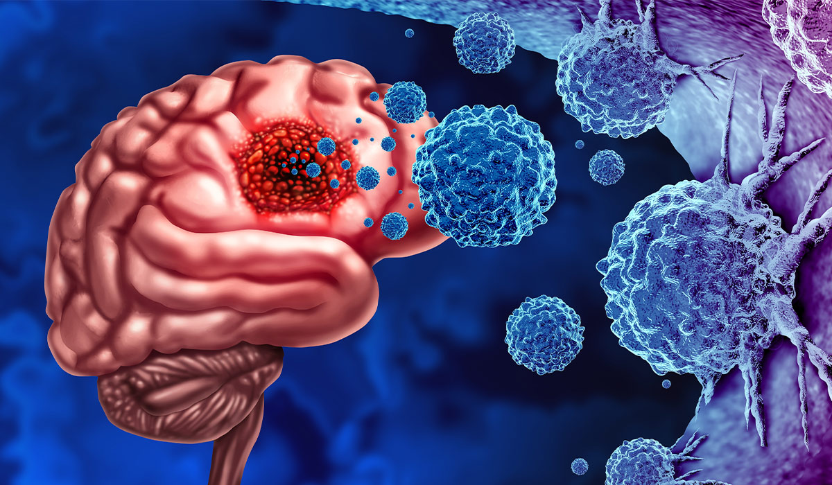 Glioblastoma: What Is, Causes, Symptoms, Diagnosis, and Treatment
