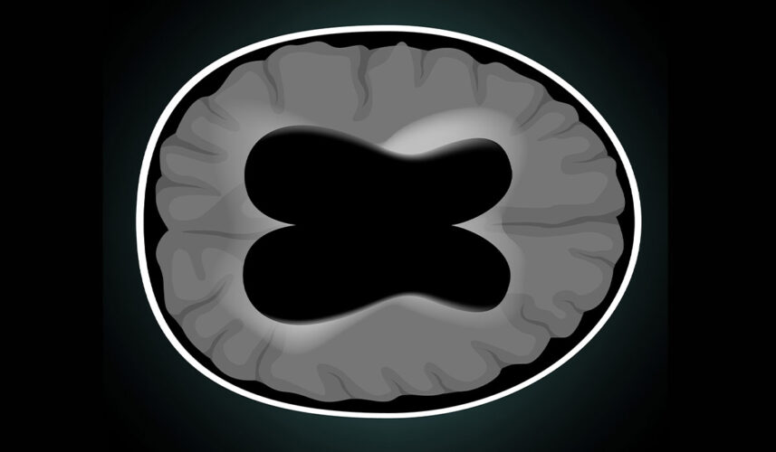 Hydrocephalus: What Is, Types, Symptoms, Diagnosis, and Treatment