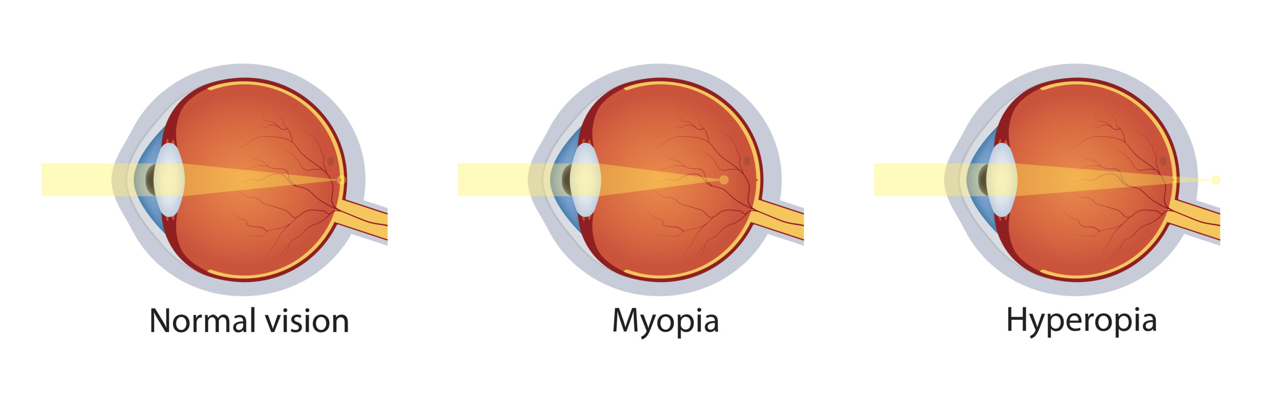 Myopia: What Is, Causes, Diagnosis, Treatment, and Prevention