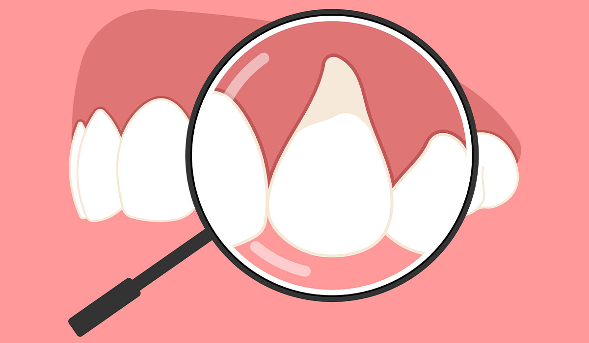 Periodontitis: What Is, Causes, Stages, Symptoms, and Treatment