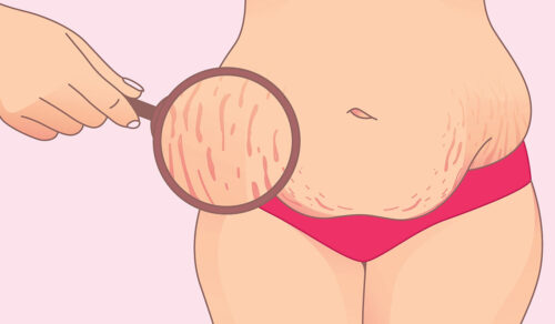 Stretch Marks: What Are, Causes, Prevention, and Self-Care