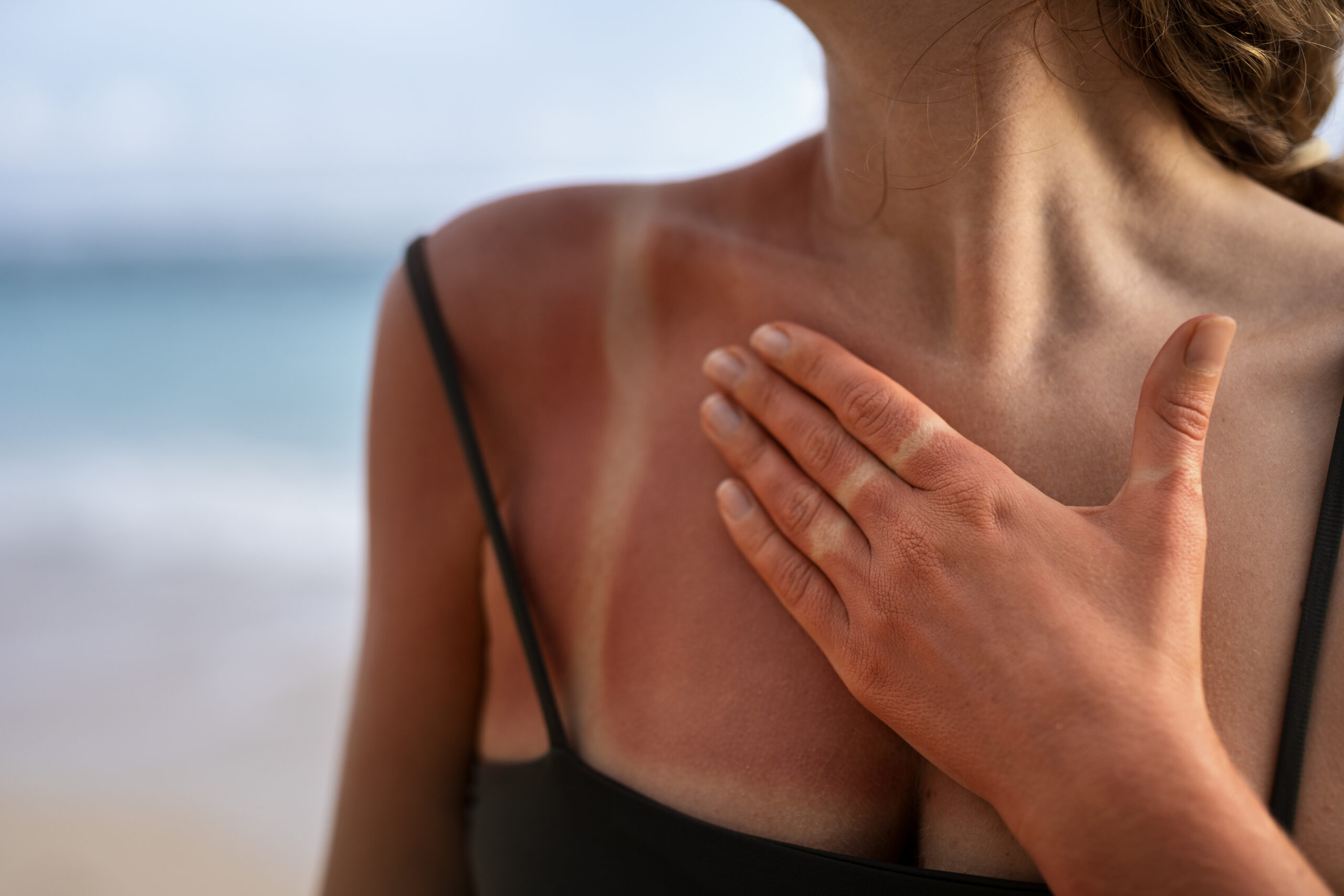 Sunburn: What Is, Symptoms, Degrees, and First Aid