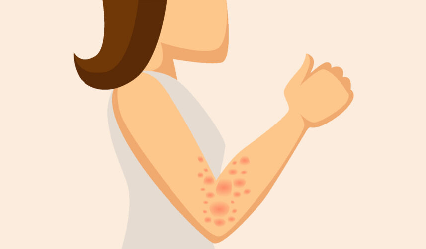 Angioedema: What Is, Classification, Causes, Symptoms, and Treatment