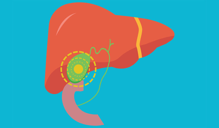 Cholecystitis: What Is, Types, Causes, Risk Factors, and Treatment