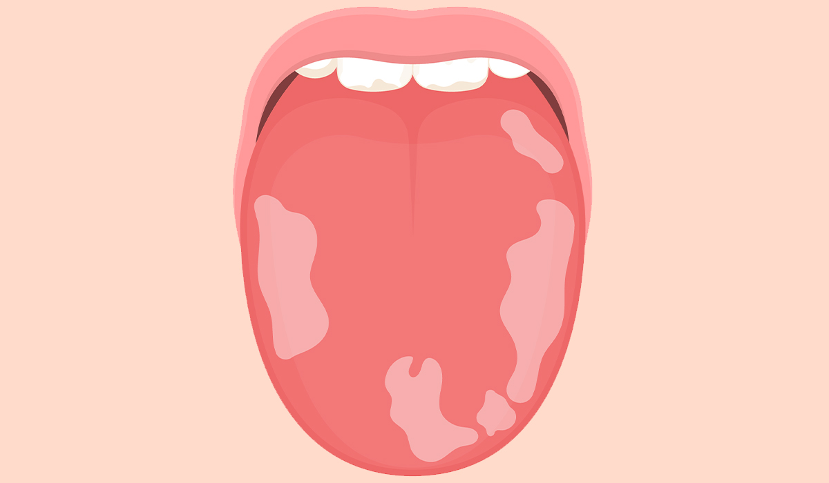 Leukoplakia: What Is, Causes, Symptoms, Diagnosis, Treatment, and Cancer Risk