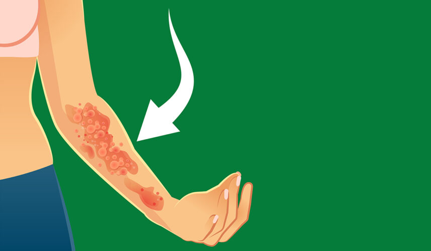 Poison Ivy Rash: What Is, Risk Factors, Symptoms, And Treatment