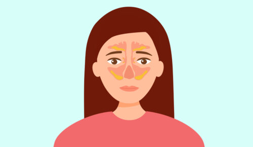 Sinusitis: What Is, Types, Causes, Symptoms, Diagnosis, Treatment, and Prevention