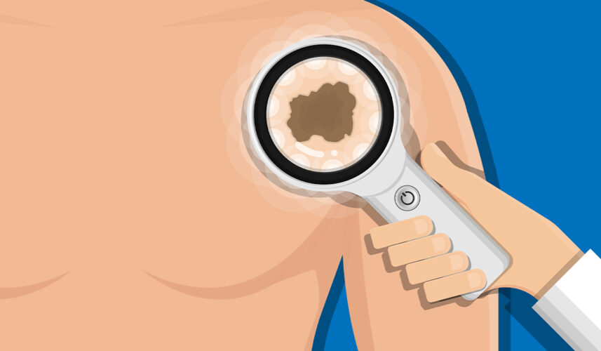 Squamous Cell Carcinoma: What Is, Types, Causes, Symptoms, and Prevention