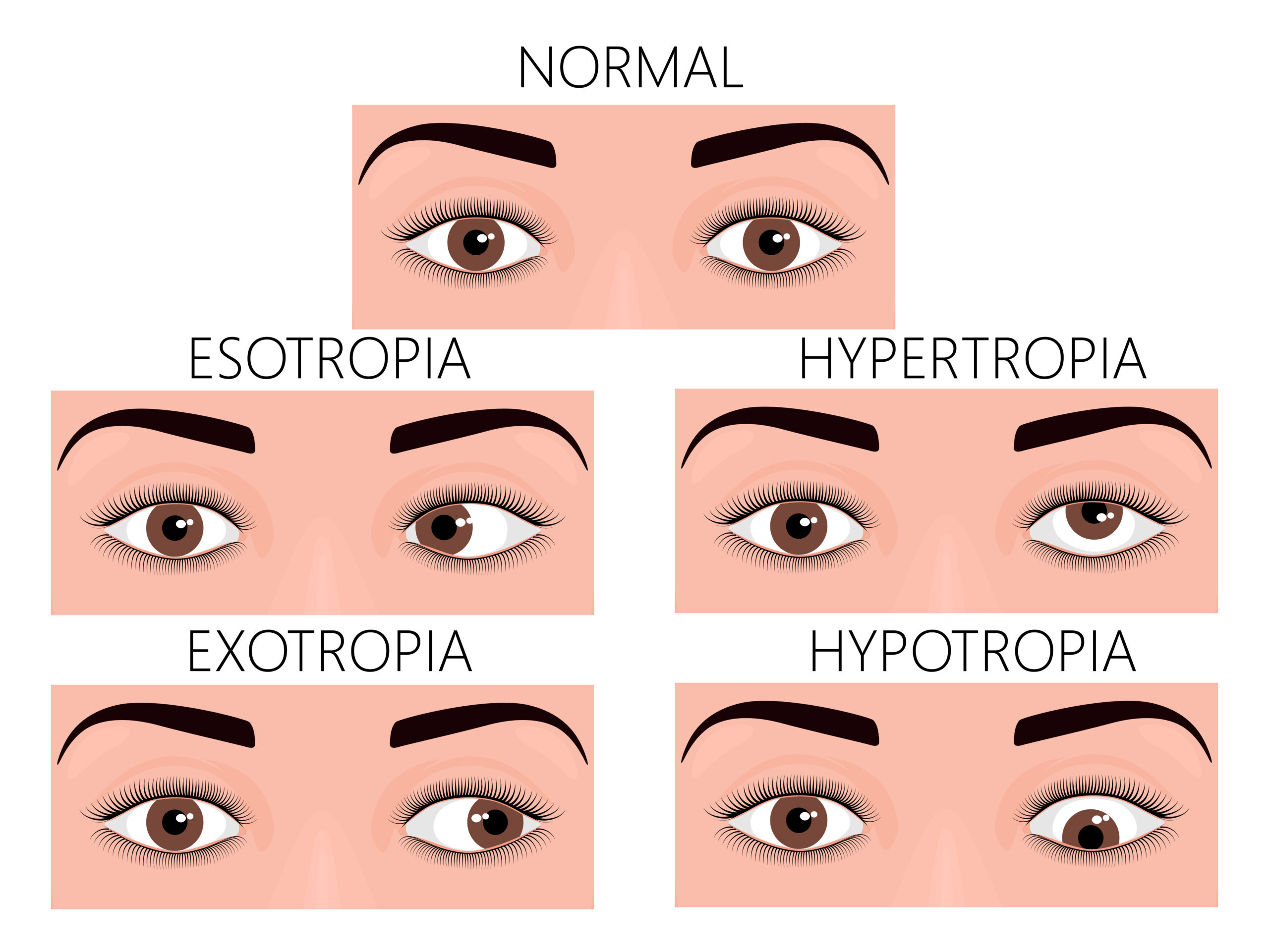 Strabismus: What Is, Causes, Types, Diagnosis, and Treatment