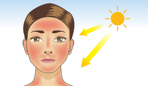 Sun Poisoning: What Is, Risk Factors, Symptoms, Diagnosis, and Treatment