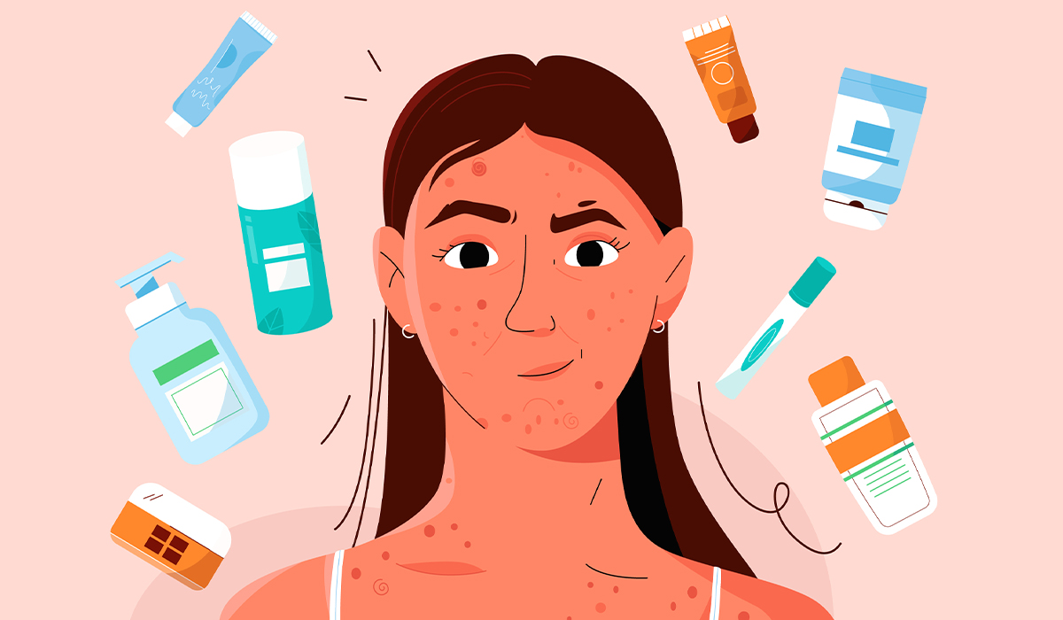 Acne: What Is, Symptoms, Causes, Diagnosis, and Skincare