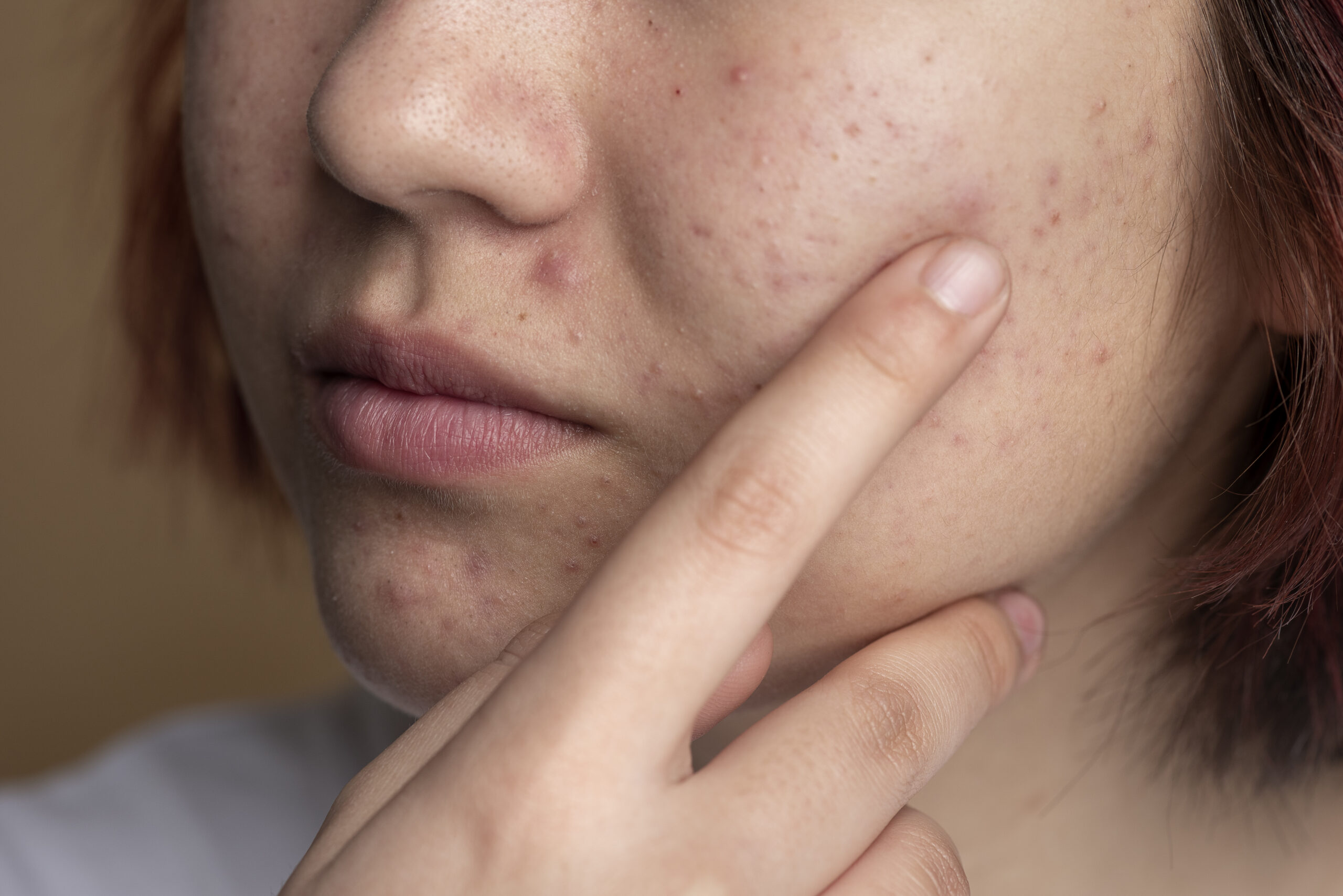 Acne: What Is, Symptoms, Causes, Diagnosis, and Skincare