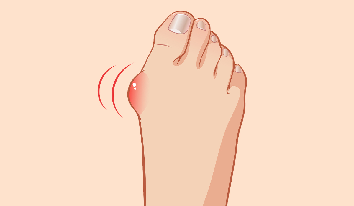 Bunion: What Is, Types, Risk Factors, Treatment, and Diagnosis