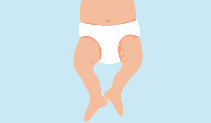 Diaper Rash: What Is, Types, Risk Factors, Symptoms, and Treatment